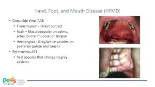 Viral Rashes in Children [upl. by Iadrahc849]