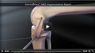 InternalBrace™ MCL Augmentation Repair [upl. by Ailemap]