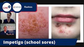 Rashes in babies and children [upl. by Fey949]