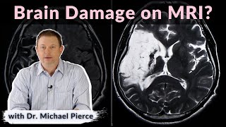 Will brain damage show on MRI [upl. by Jermaine]