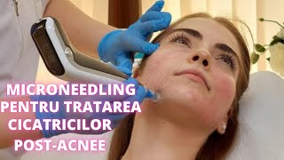 Microneedling Dermapen pentru tratarea cicatricilor postacnee  DermaBeauty Clinique [upl. by Boeke]