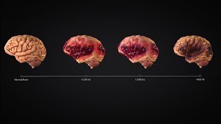 Traumatic Brain Injury Timeline Animation Charts Encephalomalacia [upl. by Linis]