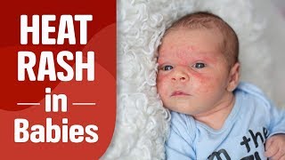 Heat Rash in Babies [upl. by Murton]